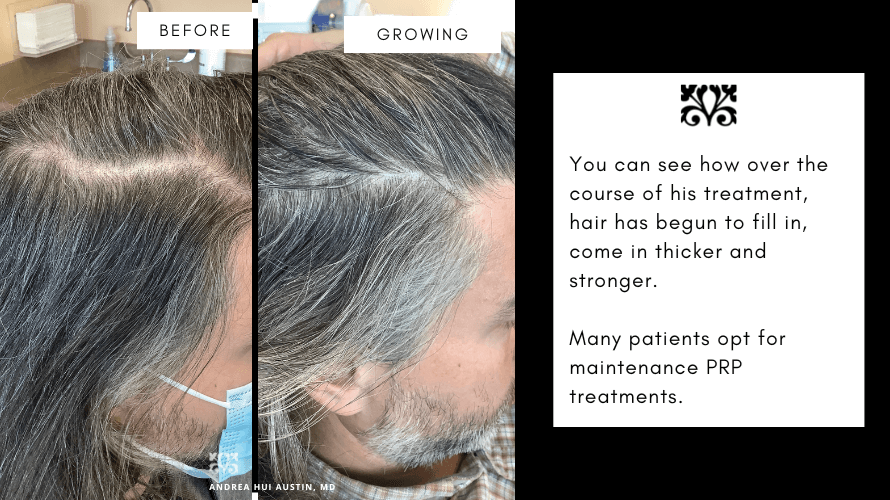 minoxidi for hair loss in san